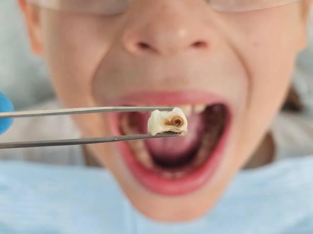Best Emergency Wisdom Tooth Extraction in Clifton, NJ